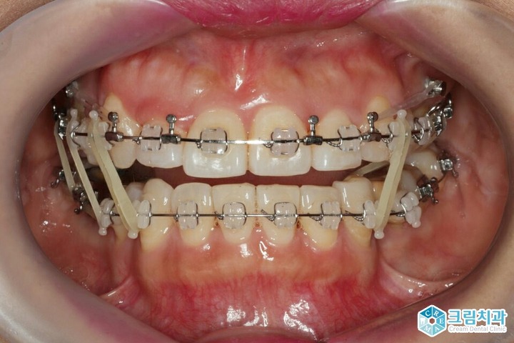 치아교정 시 고무줄로 인한 통증, 고무줄의 역할은?
