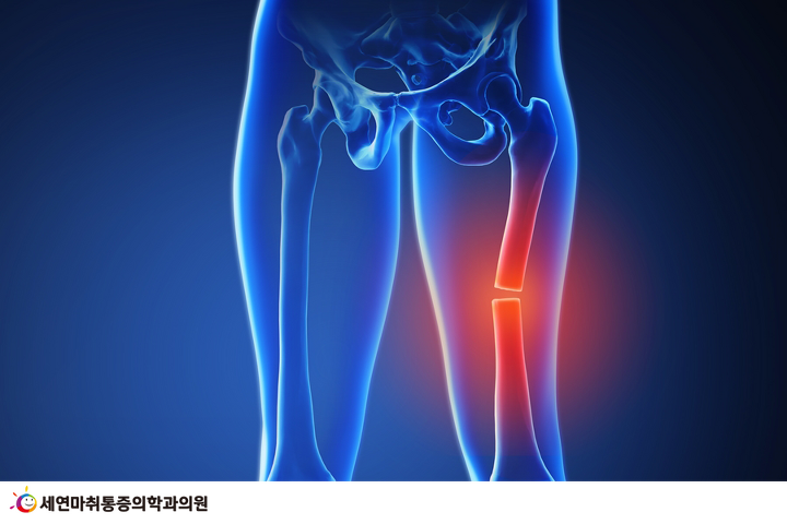 Wl 통증 허벅 뒤쪽 무릎통증, 허벅지뒤쪽통증