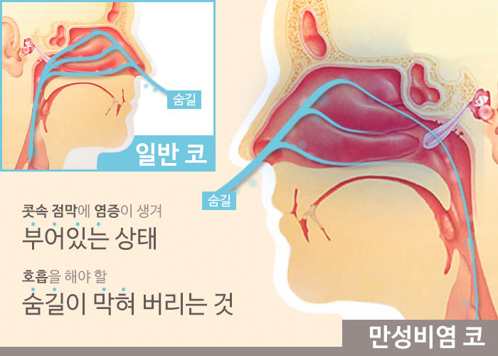 콧물이 계속 물처럼 줄줄 흐르는 이유를 어떻게 막나요